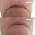 Wrinkles Schminkles Mouth & Lip Wrinkle Patch Single